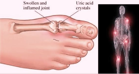 Understanding Uric Acid and Its Impact on Health.