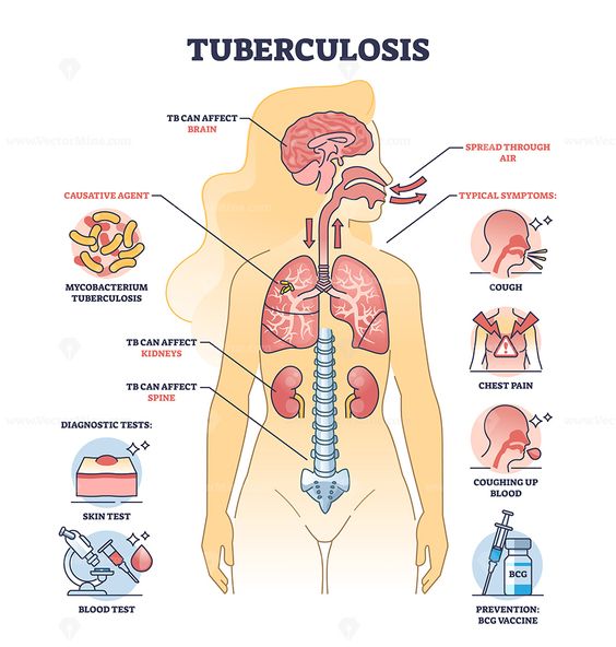 The ultimate guide on tuberculosis (TB) awareness, written in a style similar to a human’s: